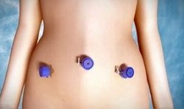 腹腔镜子宫全切术视频,腹腔镜子宫全切术操作步骤与技巧解析