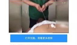 针灸疼痛视频,视频解析与疗效揭秘