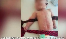 针灸疼痛视频,视频解析与疗效揭秘